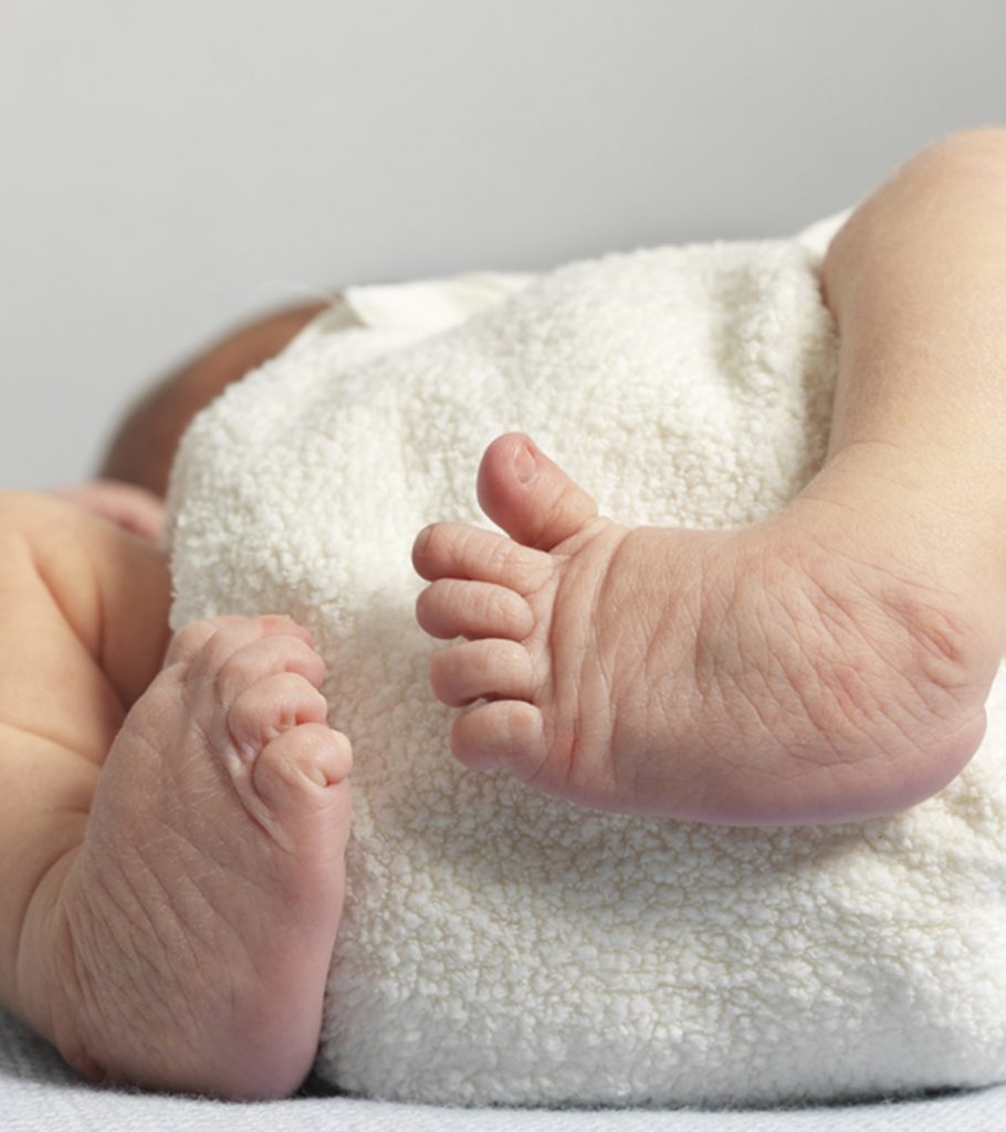 Clubfoot In Baby: Causes, Diagnosis, Treatment & Pictures