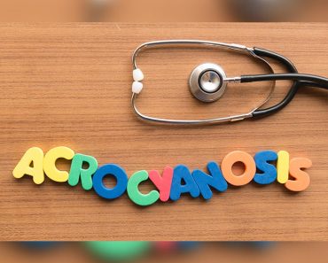 Acrocyanosis In Newborn: Causes, Symptoms And Treatment